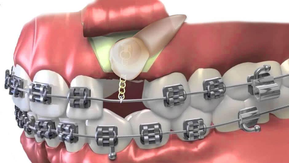 Ortodontik Yaklaşımda Kullanılan Modern Teknikler ve İmplant Destekli Çözümler