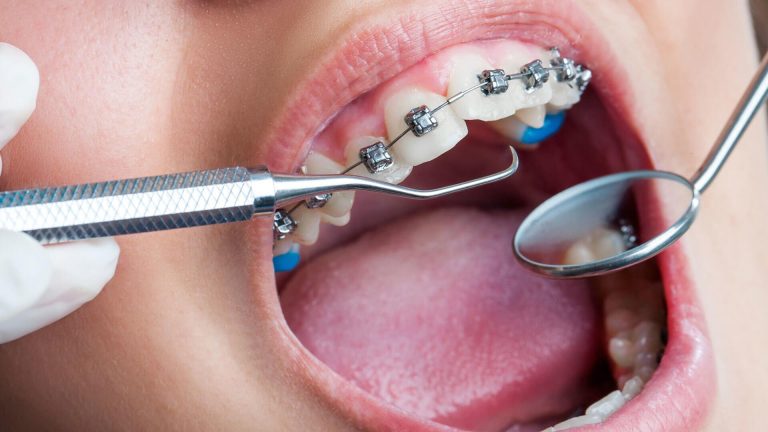 Ortodonti Uzmanı İpuçları: Braketlere Uyum Sağlamanın Yolları.