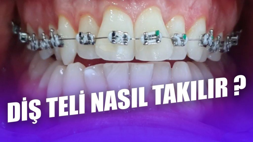 Ortodonti Uzmanının Gözünden: Diş Teli Takmak Acı Verir Mi?
