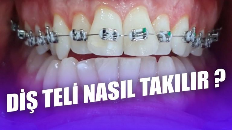Ortodonti Uzmanının Gözünden: Diş Teli Takmak Acı Verir Mi?