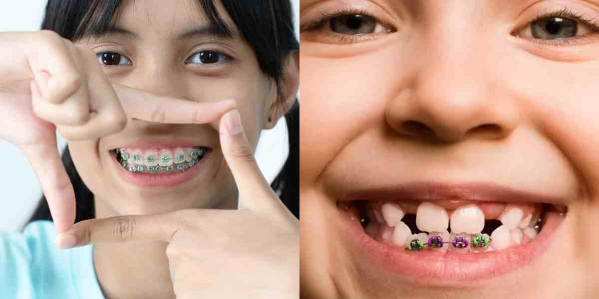 Diş Hekiminden Sık Sorulan Sorular: Çocuklarda Diş Teli Ne Kadar Süre Kalır?