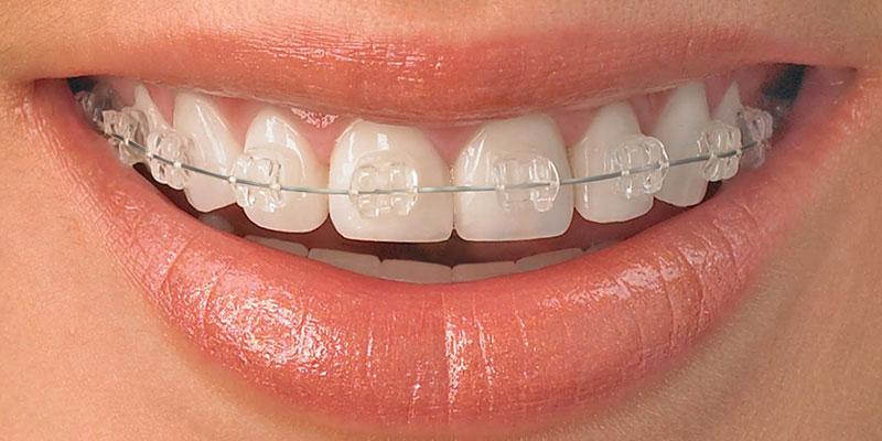 Geç Başlayan Ortodontik Müdahalelerin Diş ve Çene Sağlığı Üzerindeki Etkileri