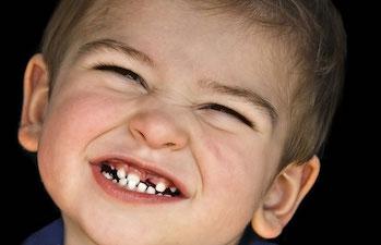 Çocuklarda Diş Gıcırdatmanın Ortodontik ve Fonksiyonel Etkileri