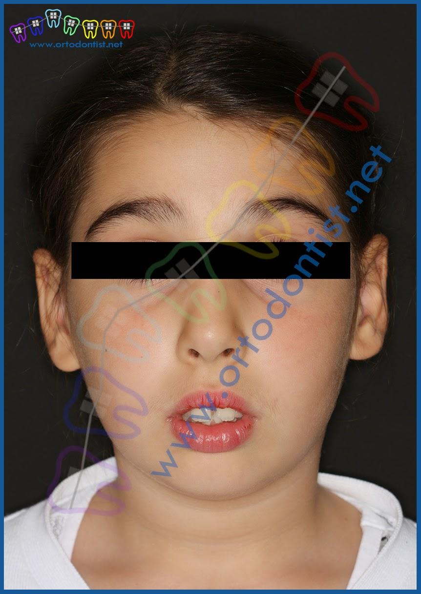 Çocuklarda Ağızdan Nefes Alma Durumunda Ortodontik Tedavi Yaklaşımları