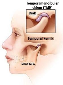 Çocuklarda TME Semptomlarının Erken Tanısı İçin Klinik Bulgular