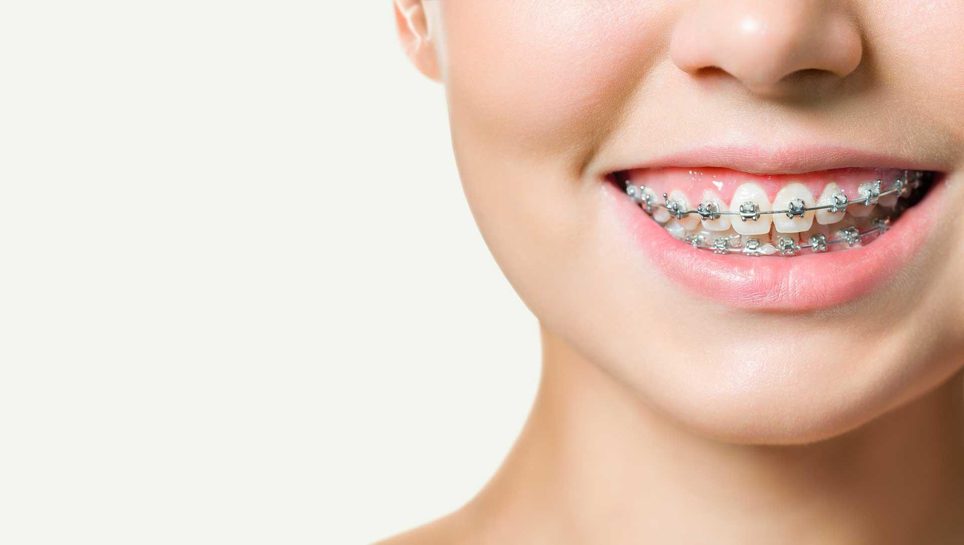 Ortodontik Tedavi Boyunca Beslenme Alışkanlıklarını Düzenleme İpuçları