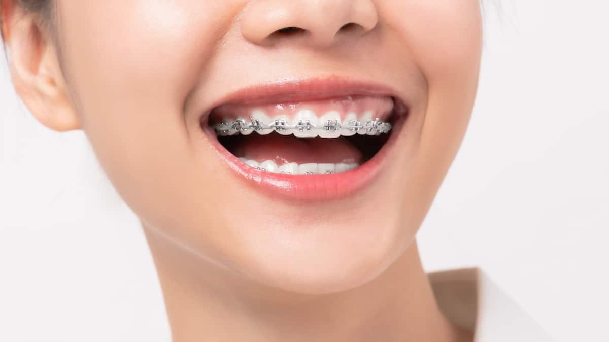 Diş Teli Sonrası Uzun Vadeli Sonuçlar İçin Antalya Diş Hekimi Önerileri