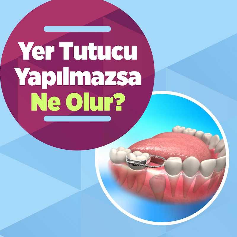 Diş Hekimi Perspektifinden Çocuklarda Yer Tutucuların Temel Fonksiyonları