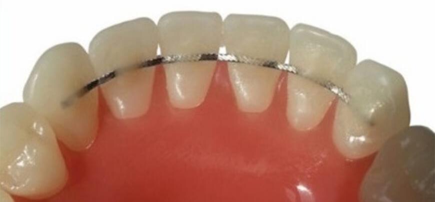 Doğru Retainer Kullanımı ve Bakım Önerileri