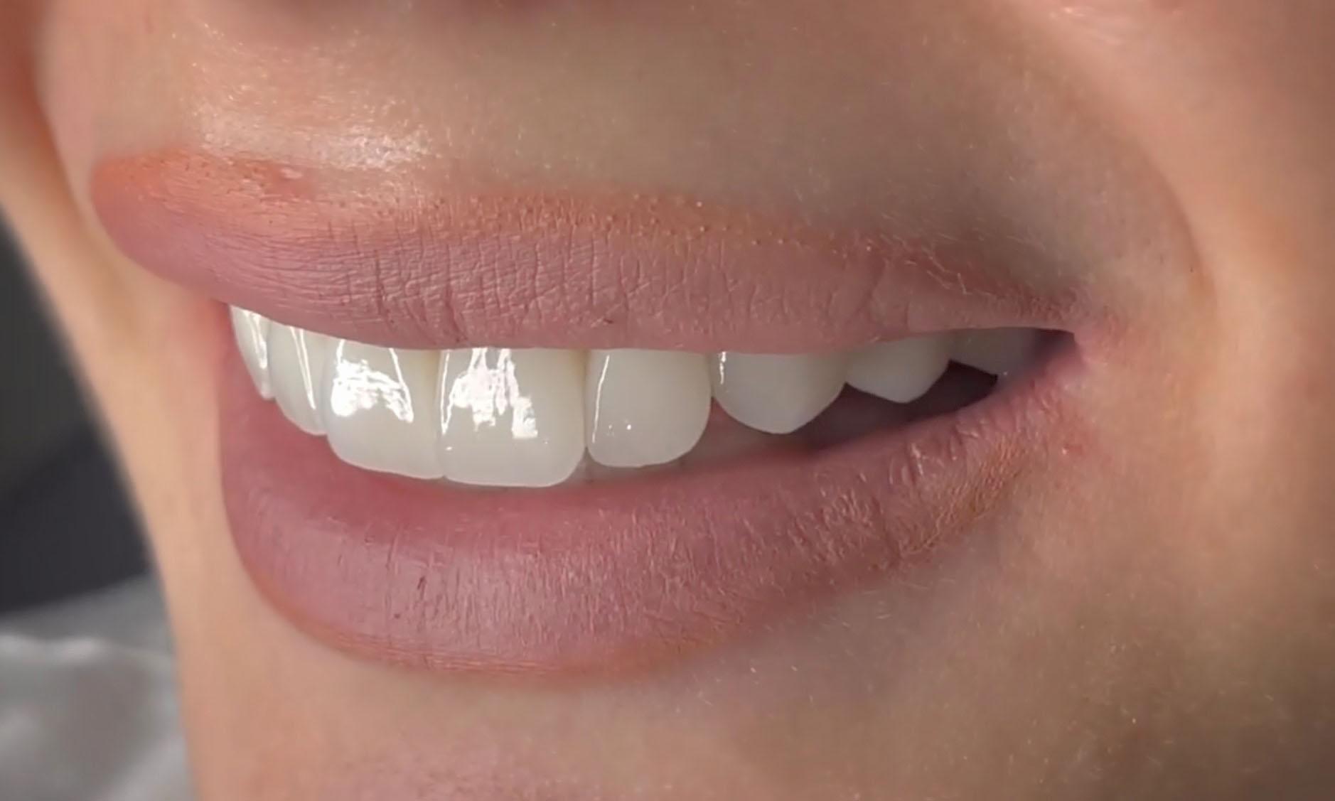 Gülüş Tasarımında Kullanılan Modern Teknikler ve Antalya Uygulamaları